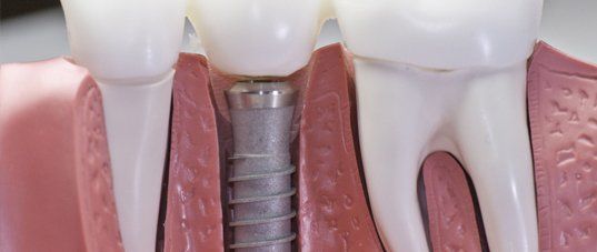 Dental implant model showing a titanium post placed in the jawbone