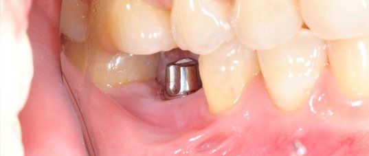 Dental implant close-up showing natural-looking result